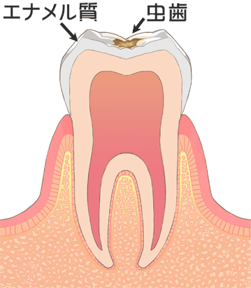 虫歯の初期
