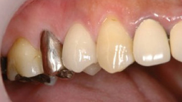 銀歯や金属が全身にもたらす影響