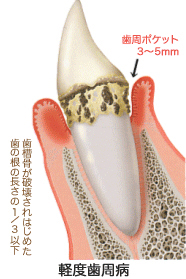虫歯の最初期