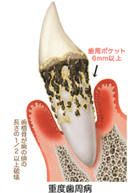 虫歯の最初期